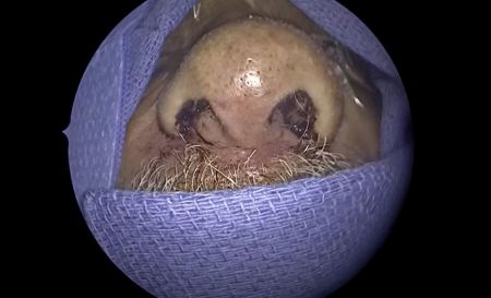 Του έβγαλαν μέσα από τη μύτη 150 ζωντανά σκουλήκια – Πώς έγινε η ανατριχιαστική διάγνωση