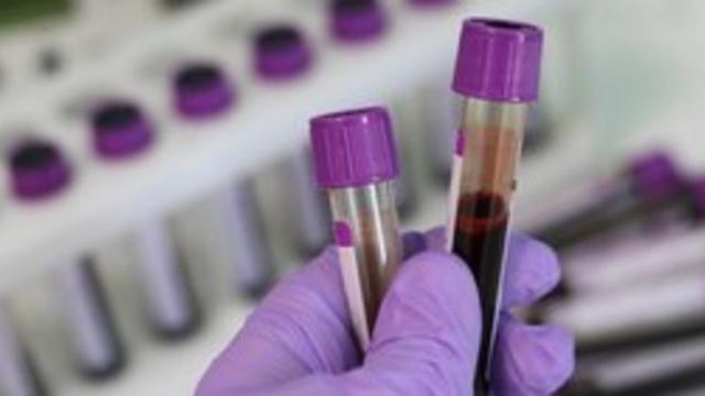 Νέο τεστ αίματος ανιχνεύει τη νόσο Αλτσχάιμερ ακόμα και 16 χρόνια νωριτερα