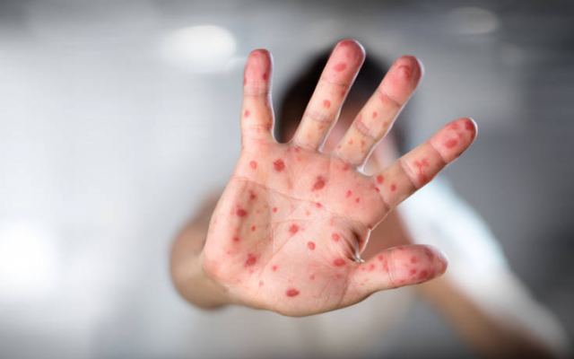 Καμπανάκι από τον ΠΟΥ: Η ιλαρά το 2018 προκάλεσε τον θάνατο 140.000 ανθρώπων