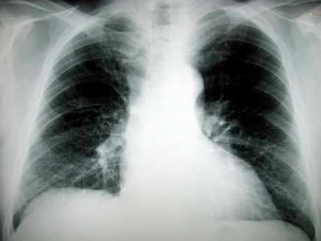 Πειραματικό αντικαρκινικό φάρμακο καταστρέφει αποτελεσματικά τους επιθετικούς καρκίνους των πνευμόνων