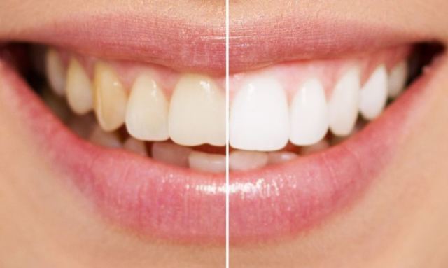 Πιο λευκά δόντια: Κάντε μπουκώματα με αυτό το φυσικό διάλυμα [vid]
