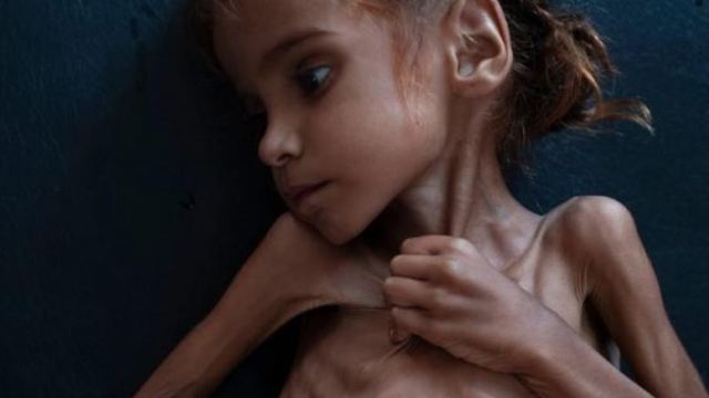 New York Times: Πέθανε η 7χρονη σύμβολο του λιμού στην Υεμένη