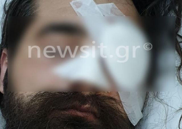 Απίστευτος τραυματισμός φιλάθλου στο ΟΑΚΑ! Έχασε το μάτι του από επίθεση αστυνομικού – pics