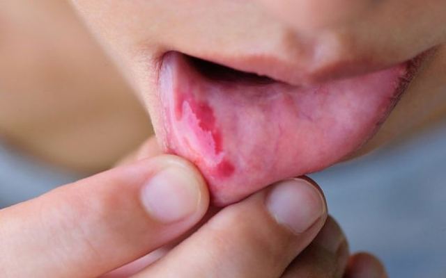 Έλκη στο στόμα: Απαλλαγείτε με αυτά τα 6 «γιατροσόφια»