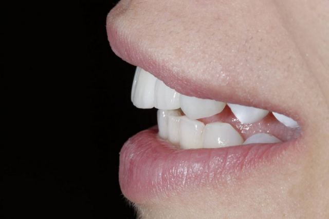 Πώς το Bonding μπορεί να αλλάξει την εμφάνιση και την αίσθηση των δοντιών σας
