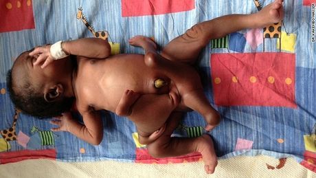 Εγχειρίστηκε και αναρρώνει στην Ουγκάντα αγοράκι που γεννήθηκε με τέσσερα χέρια και τέσσερα πόδια