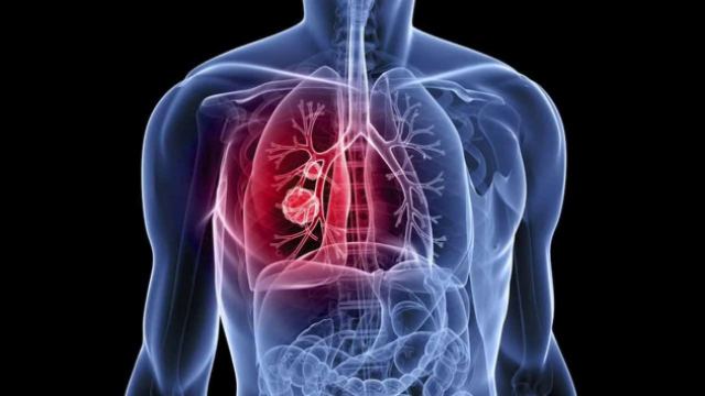 Μικροκυτταρικός καρκίνος του πνεύμονα: Τα συμπτώματα του πολύ επιθετικού καρκίνου