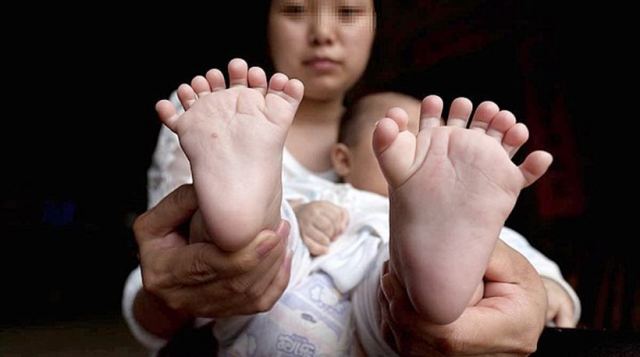 Γεννήθηκε μωράκι με 31 δάχτυλα σε χέρια και πόδια