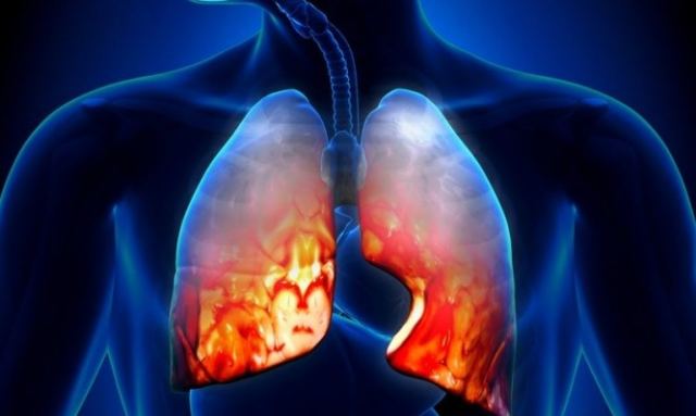 Πνευμονία: Αίτια, συμπτώματα, επιπλοκές και θεραπεία
