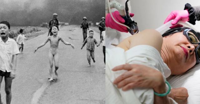 To «κορίτσι της Ναπάλμ» υποβλήθηκε στην τελική θεραπεία - Μισό αιώνα μετά τη συγκλονιστικότερη φωτογραφία του πολέμου του Βιετνάμ