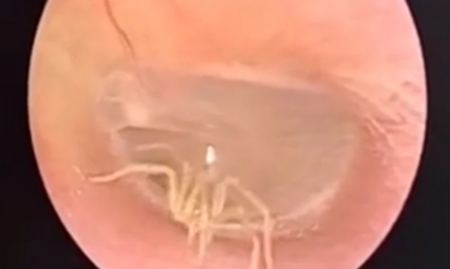 Γιατρός έβαλε κάμερα στο αυτί ασθενούς για να το εξετάσει και ήρθε αντιμέτωπος με… μια αράχνη