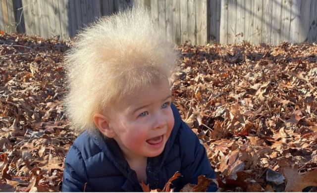 Viral παιδάκι με «ηλεκτρισμένα μαλλιά» - Το σπάνιο σύνδρομο που έχουν μόλις 100 άνθρωποι στον κόσμο