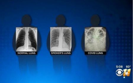 Έτσι είναι οι πνεύμονες ενός ασθενή με κορωνοϊό, ενός καπνιστή και ενός υγιούς ανθρώπου