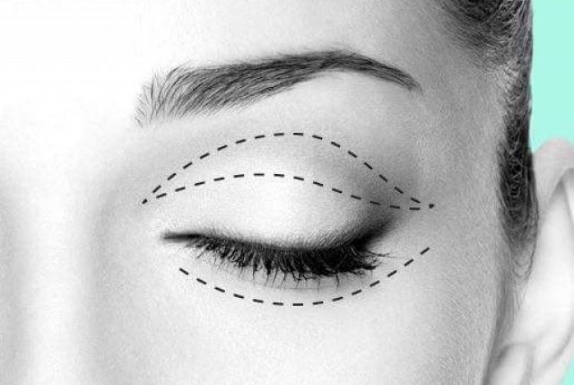 Βλεφαροπλαστική (Blepharoplasty ή Eyelid Surgery)
