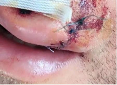 Λάρισα: Σοκάρουν οι εικόνες με τους τραυματισμένους αστυνομικούς από επίθεση 30 ατόμων – Ο ρόλος νεαρού ποδηλάτη