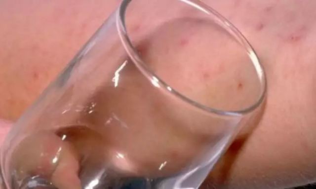 Το σημάδι στο δέρμα από μηνιγγίτιδα: Πώς γίνεται το “τεστ με το ποτήρι”