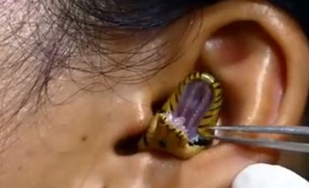 Ανατριχιαστικό βίντεο: «Χειρουργός» παλεύει να αφαιρέσει ζωντανό φίδι από το αυτί μιας γυναίκας