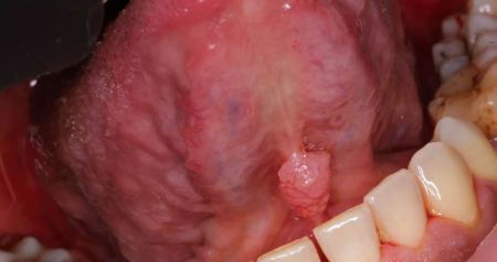 Ιός των ανθρωπίνων θηλωμάτων (HPV) στο στόμα: Τι πρέπει να γνωρίζετε