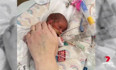 Η συγκλονιστική ιστορία του μωρού που γεννήθηκε πρόωρα με έναν όγκο διπλάσιο από το μέγεθός του – Είναι «θαύμα»