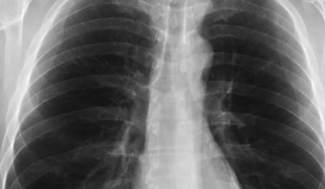 Τι είναι το σύνδρομο λευκού πνεύμονα: Η μυστηριώδης κινέζικη πνευμονία που προκαλεί παγκόσμια ανησυχία (ΒΙΝΤΕΟ)