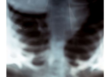 Καρκίνος του πνεύμονα: Νέο φάρμακο καταγράφει εντυπωσιακά αποτελέσματα για το 60% των ασθενών