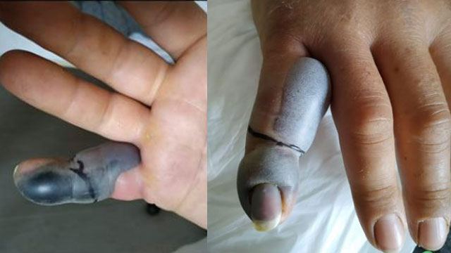 Έσωσαν το δάχτυλό του μετά από δάγκωμα οχιάς