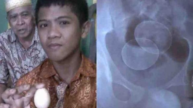 Ιατρικό μυστήριο: Ενας 14χρονος «γεννά» αυγά στην Ινδονησία