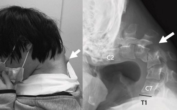 Σπάνιο ιατρικό περιστατικό: «Έπεσε» ο αυχένας του γιατί χρησιμοποιούσε για χρόνια σκυφτός το κινητό του