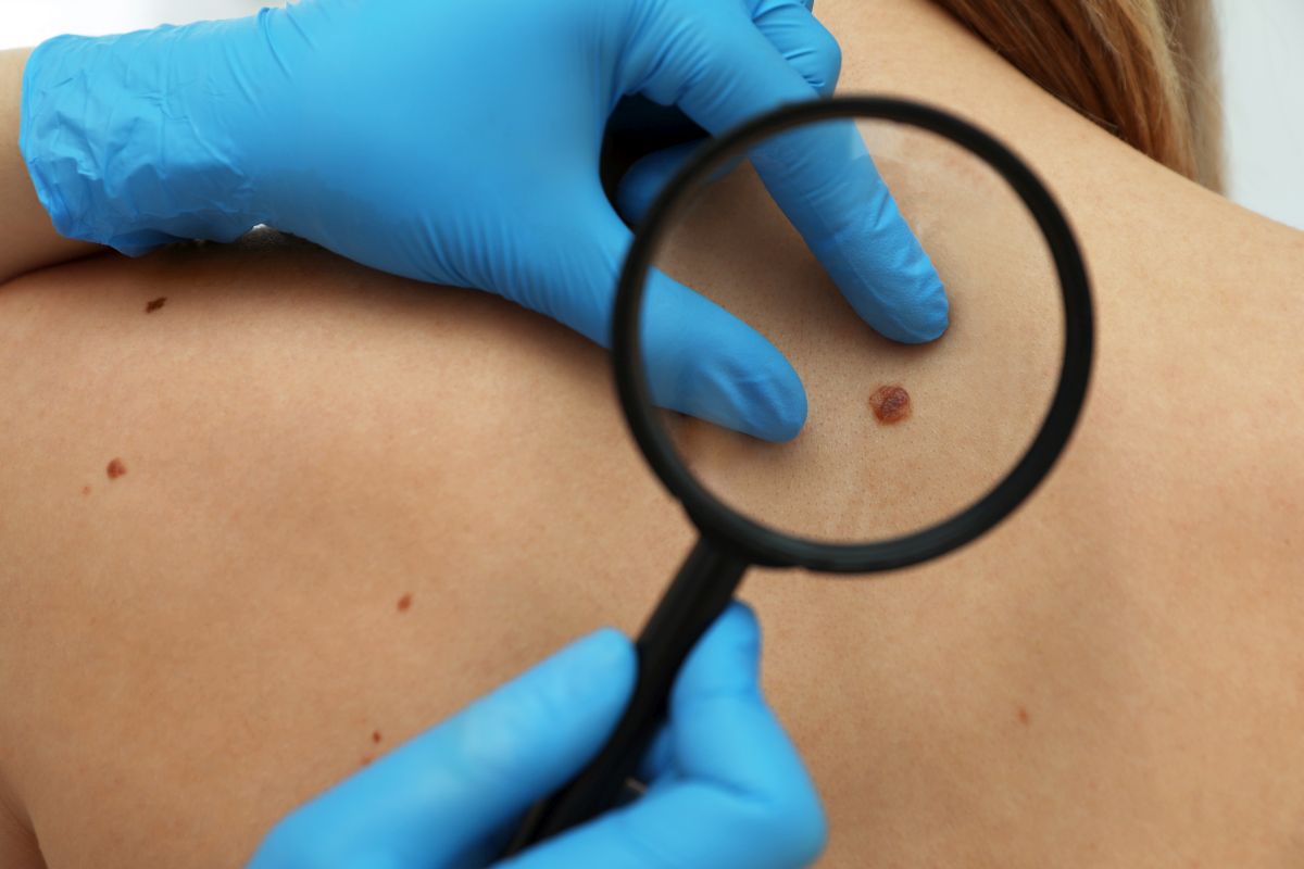 Λαμία: Σήμερα Τρίτη εξεταζόμαστε για το μελάνωμα