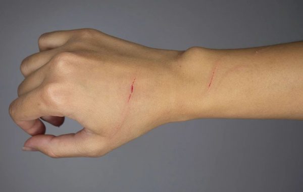 Τη γρατζούνισε ένα κουτάβι και δεν έδωσε σημασία, αλλά τελικά της στοίχισε τη ζωή