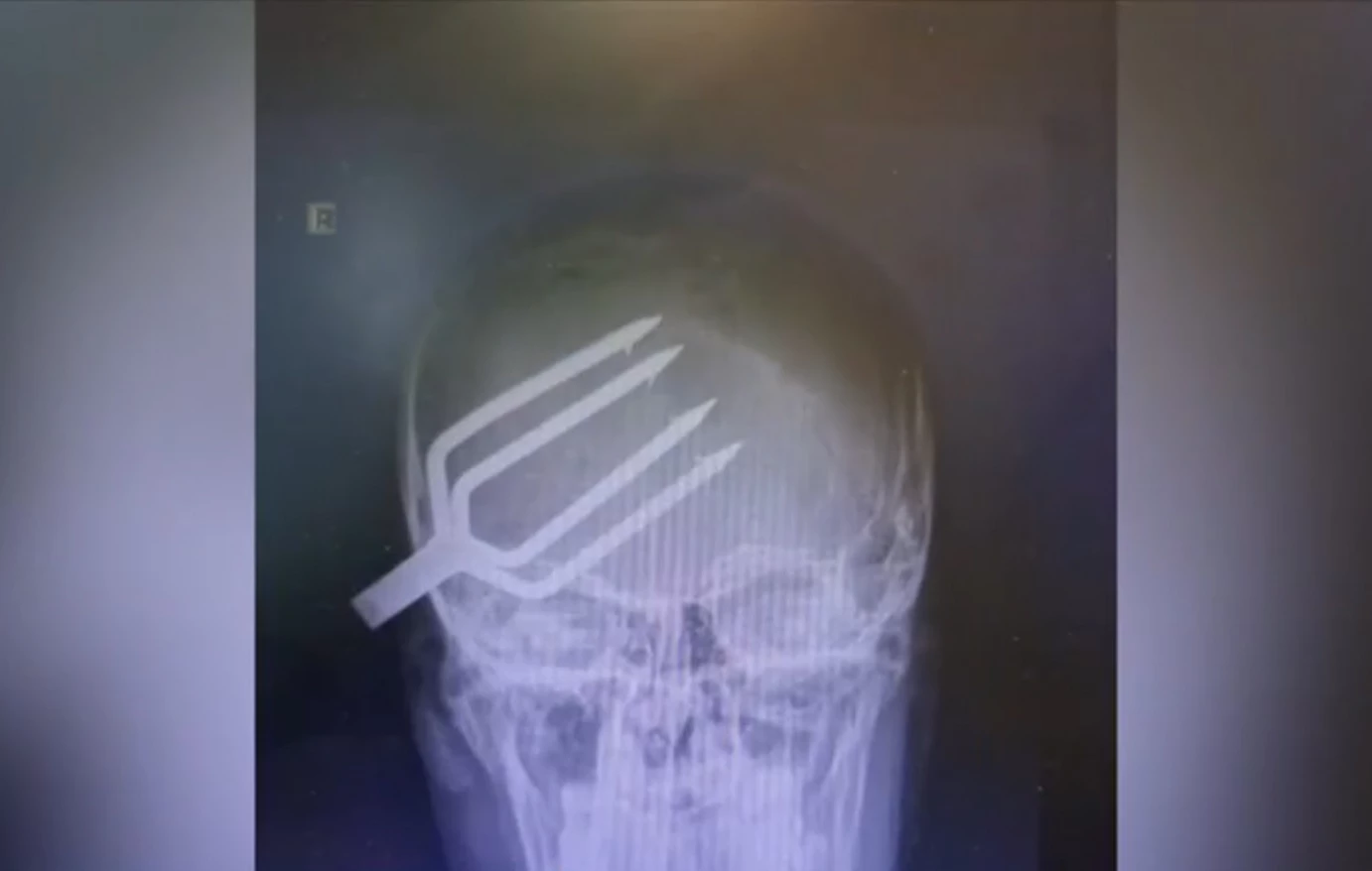 Βγήκε από το νοσοκομείο ο 14χρονος που του είχε καρφωθεί καμάκι από ψαροντούφεκο στο κρανίο