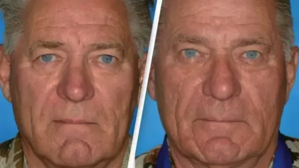 Σοκαριστικές διαφορές στην εμφάνιση: Τι αποκάλυψε μελέτη για δίδυμους... καπνίζοντες και μη