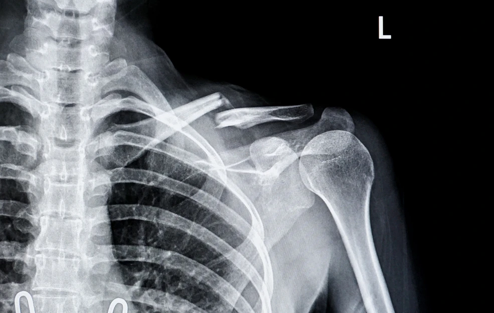 «Κόλλα οστών» που θεραπεύει τα κόκαλα σε τρία λεπτά ανέπτυξαν Κινέζοι επιστήμονες