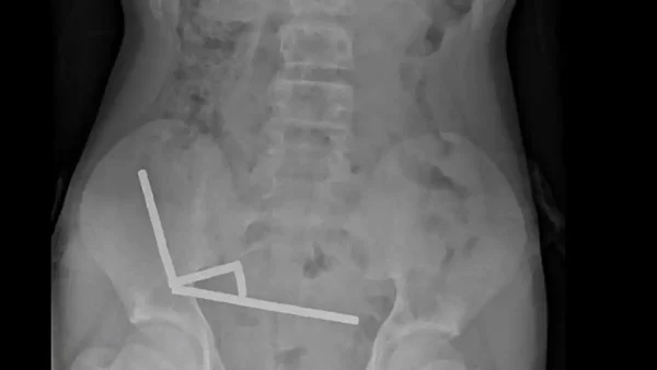 Νέα Ζηλανδία: Γιατροί αφαίρεσαν δεκάδες μαγνήτες από έντερο 13χρονου