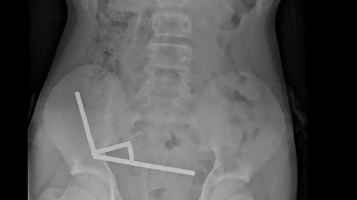 Νέα Ζηλανδία: Γιατροί αφαίρεσαν δεκάδες μαγνήτες από έντερο 13χρονου