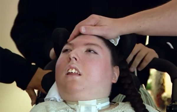 Το «ιατρικό θαύμα» της γυναίκας που γεννήθηκε σχεδόν χωρίς εγκέφαλο και έγινε 20 ετών – Είχαν πει ότι δεν θα ζούσε πάνω από 5 χρόνια