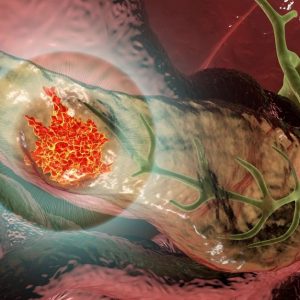 Βρέθηκε θεραπεία για τον καρκίνο του παγκρέατος; Τι πρέπει να γνωρίζετε για τη νέα σπουδαία ανακάλυψη