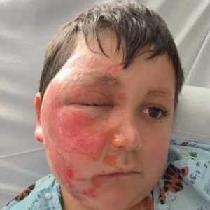 Το επικίνδυνο challenge του TikTok με φούρνο μικροκυμάτων: 9χρονος υπέστη σοβαρά εγκαύματα (ΒΙΝΤΕΟ)