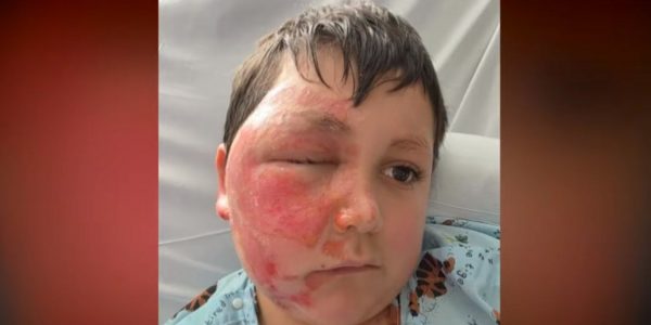 Το επικίνδυνο challenge του TikTok με φούρνο μικροκυμάτων: 9χρονος υπέστη σοβαρά εγκαύματα (ΒΙΝΤΕΟ)