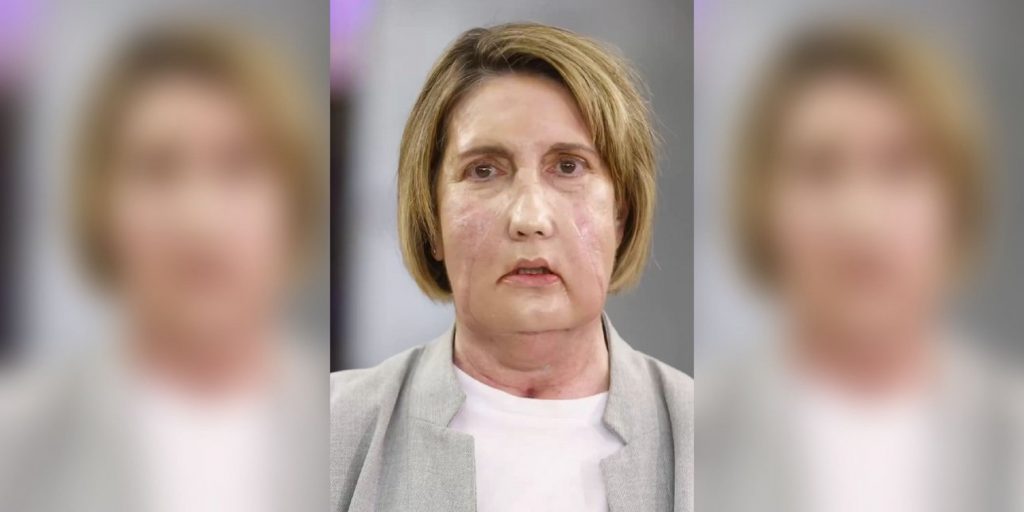 Γιατροί στην Ισπανία έγραψαν ιστορία: Η πρώτη μεταμόσχευση προσώπου με δότρια που υποβλήθηκε σε υποβοηθούμενη ευθανασία