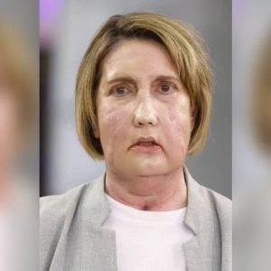 Γιατροί στην Ισπανία έγραψαν ιστορία: Η πρώτη μεταμόσχευση προσώπου με δότρια που υποβλήθηκε σε υποβοηθούμενη ευθανασία