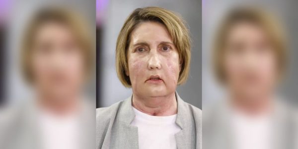 Γιατροί στην Ισπανία έγραψαν ιστορία: Η πρώτη μεταμόσχευση προσώπου με δότρια που υποβλήθηκε σε υποβοηθούμενη ευθανασία