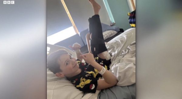 Ηνωμένο Βασίλειο: 9χρονος «ψήλωσε» 3 εκατοστά χάρη σε πρωτοποριακή επέμβαση