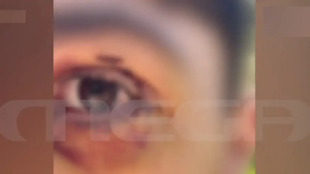 Ιωάννινα: Άγριος ξυλοδαρμός 16χρονου από ανήλικους – «Πήγε βόλτα και κινδύνευσε να χάσει την όρασή του» λέει η μητέρα του