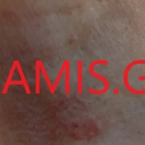 Πάτρα: Λαγοκέφαλος δάγκωσε γυναίκα κοντά στην καρωτίδα