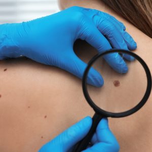 Ελπίδες για το μελάνωμα από νέο εμβόλιο mRNA - Μελετάται η χρήση του και σε άλλους καρκίνους