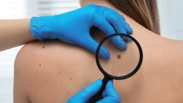Ελπίδες για το μελάνωμα από νέο εμβόλιο mRNA - Μελετάται η χρήση του και σε άλλους καρκίνους
