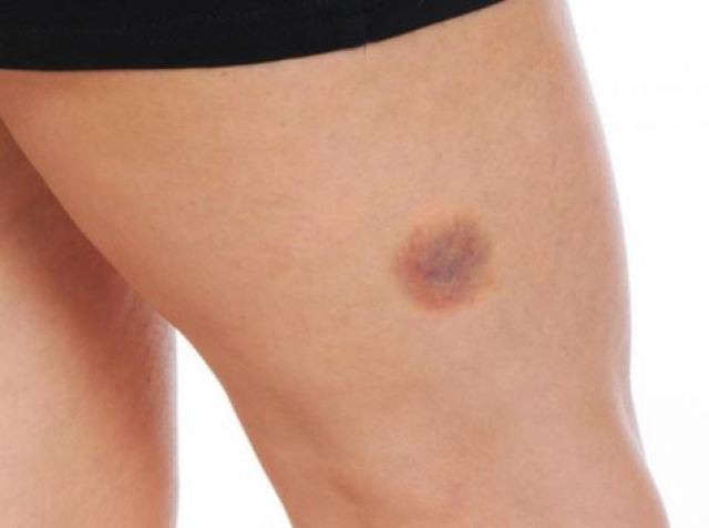 Προσοχή αν κάνετε μελανιές «χωρίς λόγο» – Τι μπορεί να σας συμβαίνει