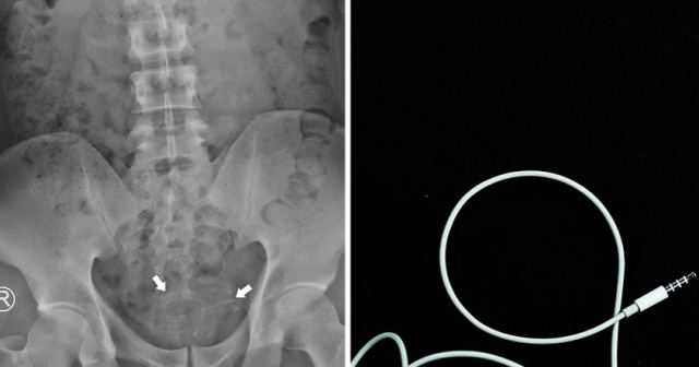 Πήγε με στομαχόπονο στο νοσοκομείο και βρέθηκε με καλώδιο ακουστικών στην ουρήθρα του
