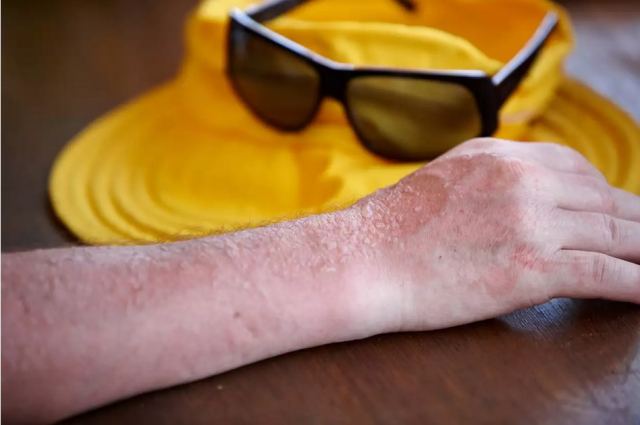 Εξάνθημα από τον ιδρώτα και την ζέστη: Τι να βάλετε για να περάσει